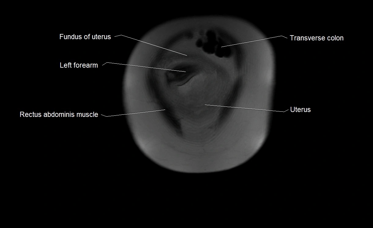 MRI Anatomy of pregnancy image 3.webp